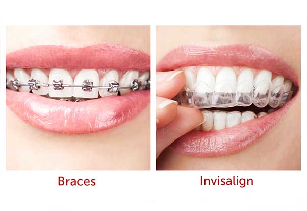 How Does Invisalign Work Compared To Braces