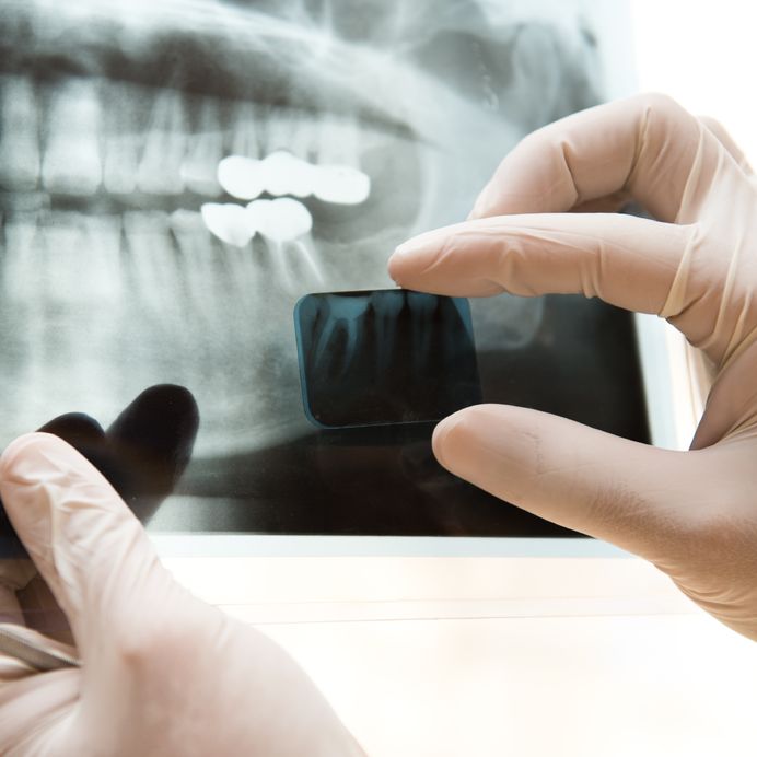 The Benefits of Dental X-Rays