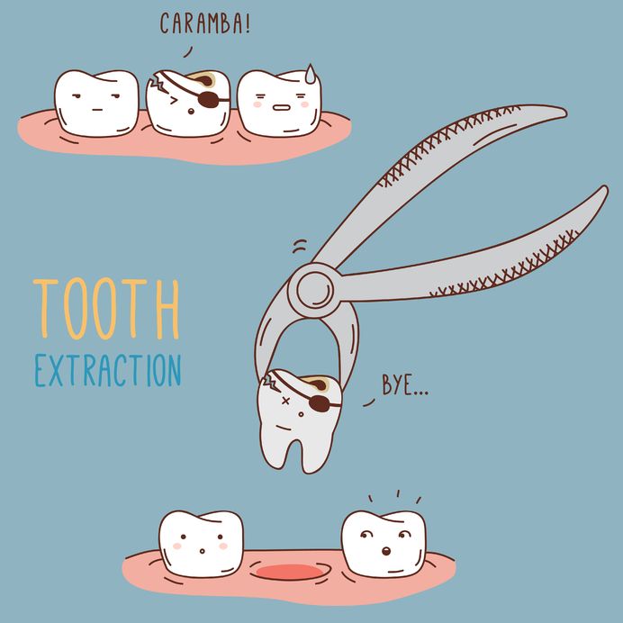The Reasons Behind a Tooth Extraction